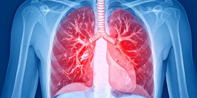 La falta de aire y el dolor punzante son las claves del Tromboembolismo Pulmonar (TEP), un «tapón» arterial que puede ser mortal