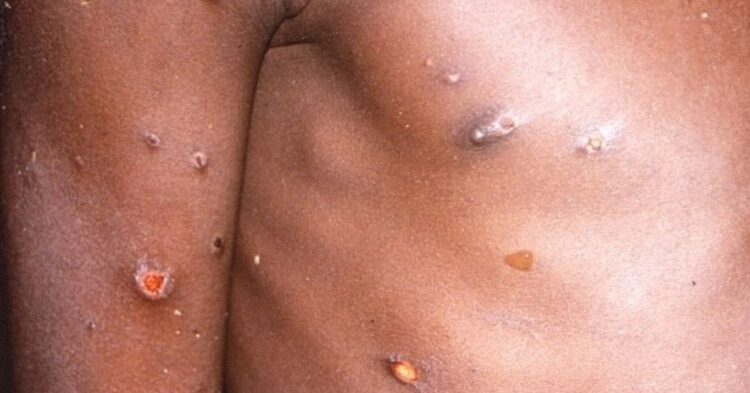 Sanidad confirma en Ceuta el primer caso de viruela del mono en un menor acogido Sanidad confirma en Ceuta el primer caso de viruela del mono en un menor acogido
